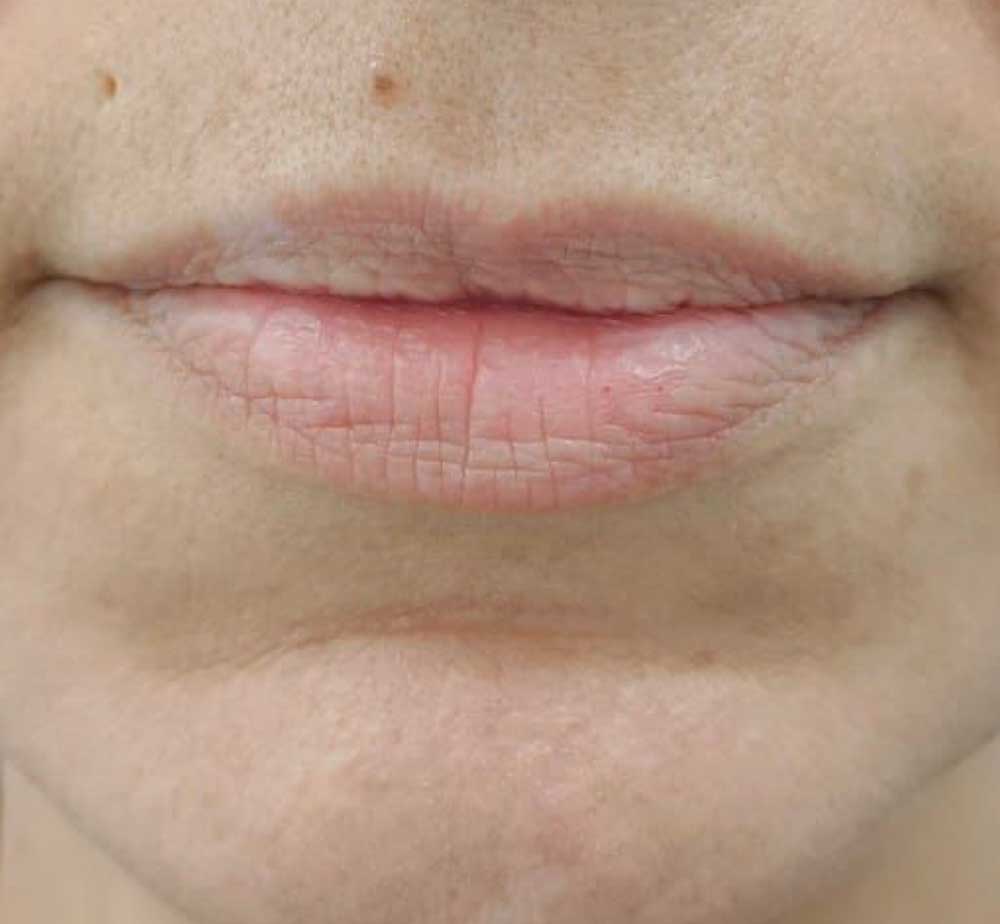 Labios antes 2