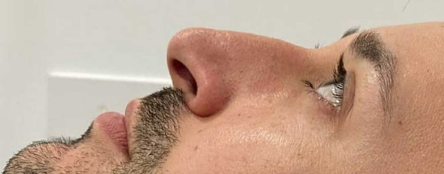 Rinomodelación antes