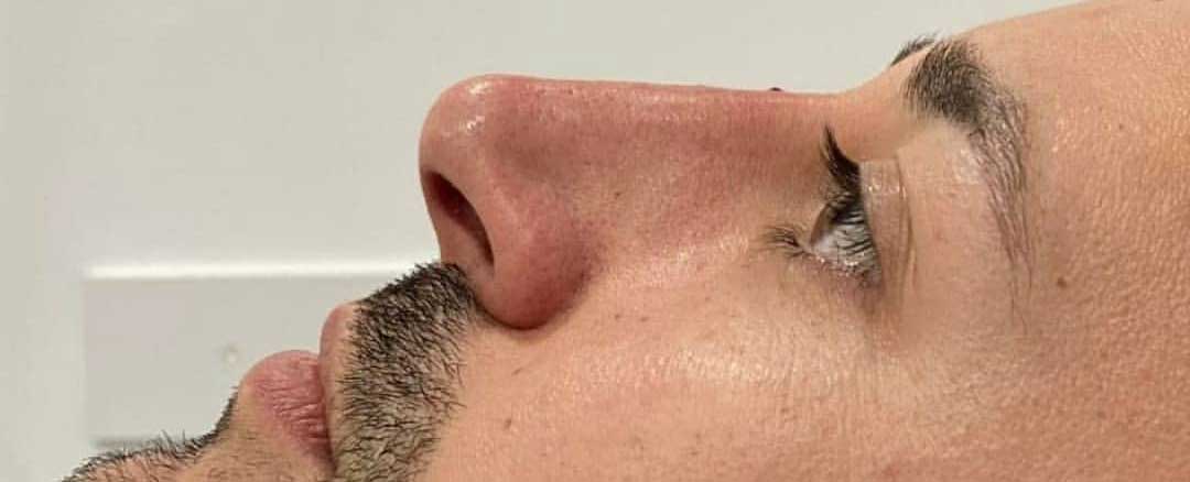 Rinomodelación después